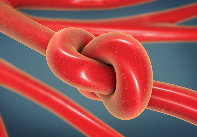 Knoten im Darm bei Verstopfung